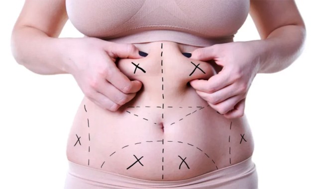 Göbek Yağı Aldırma (Liposuction) Nedir?;