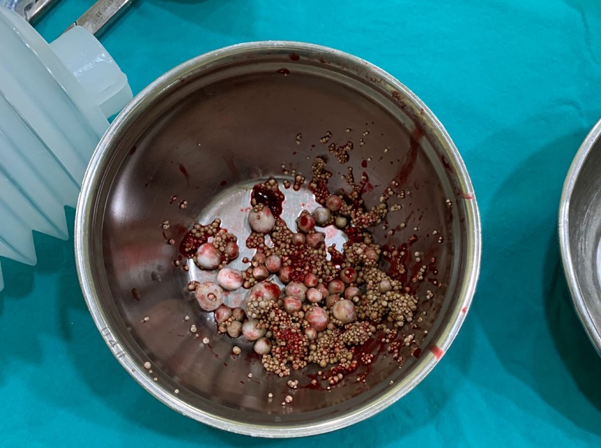 Hastadan 400 gram prostat, 100 adet taş çıkarıldı;
